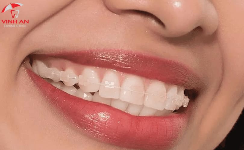 Các Loại Niềng Răng