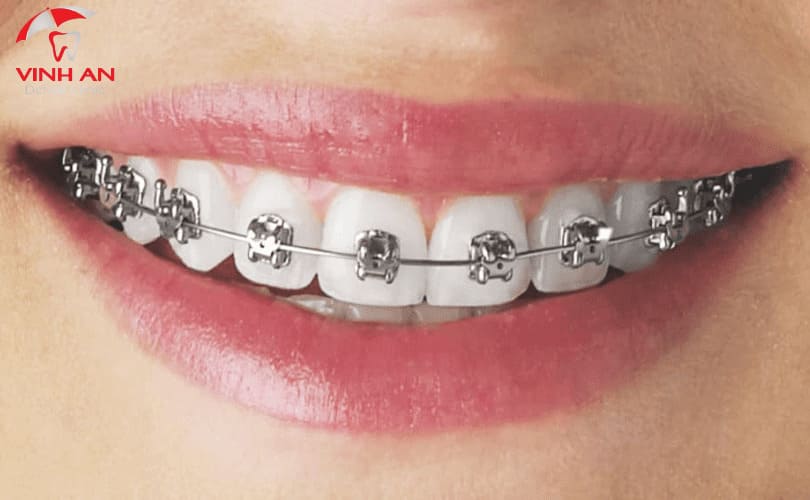 Các Loại Niềng Răng