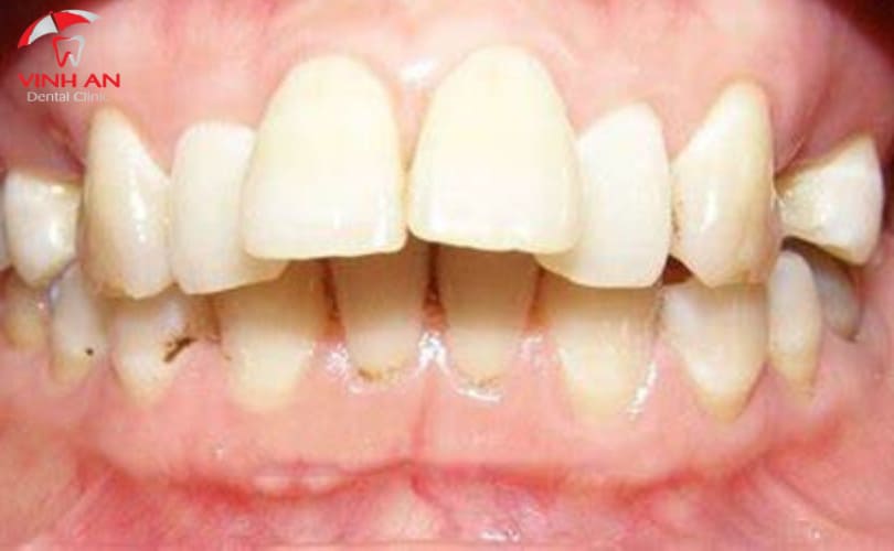 Niềng Răng 1 Hàm