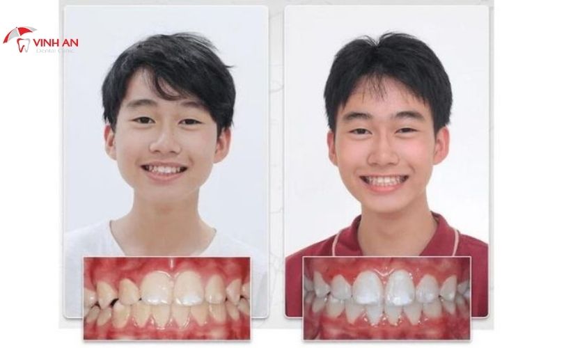 niềng răng bao lâu thì tháo