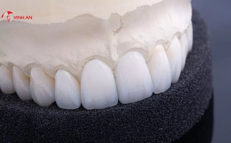 Bọc sứ răng cửa bao nhiêu tiền