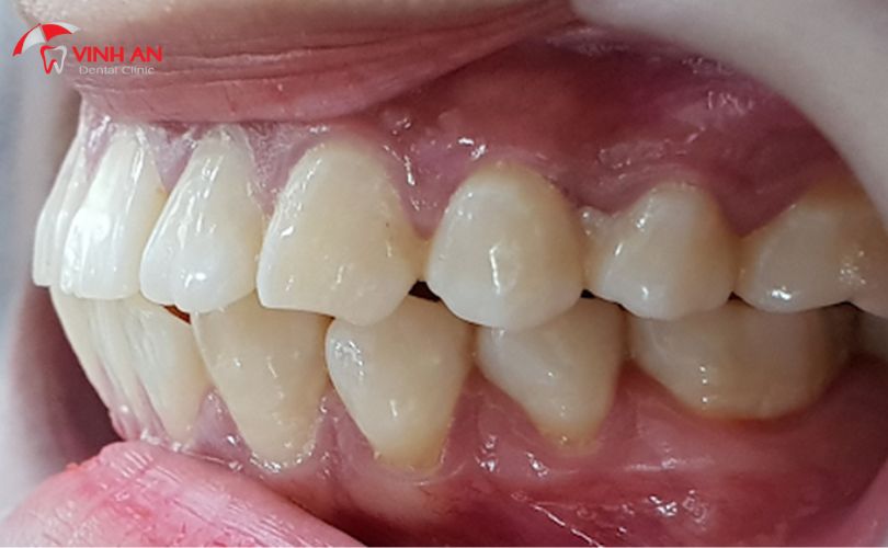 Bọc Sứ 4 Răng Cửa Giá Bao Nhiêu (8)