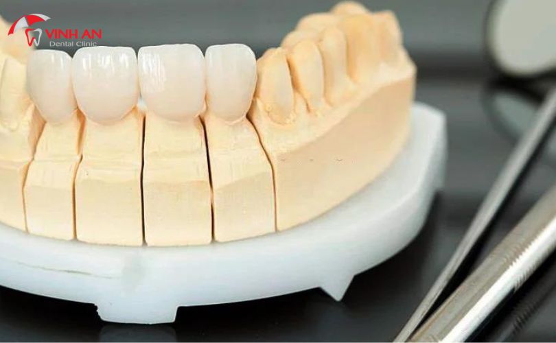 Bọc Sứ 4 Răng Cửa Giá Bao Nhiêu (9)