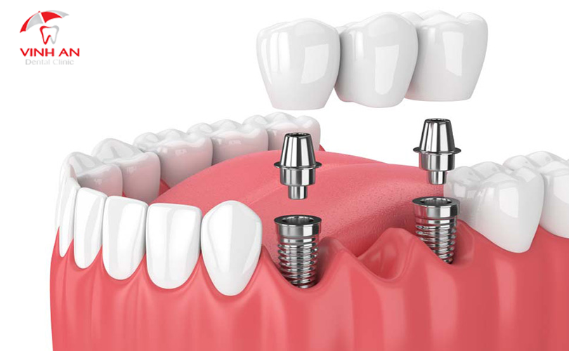 Có Nên Trồng Răng Implant Không?