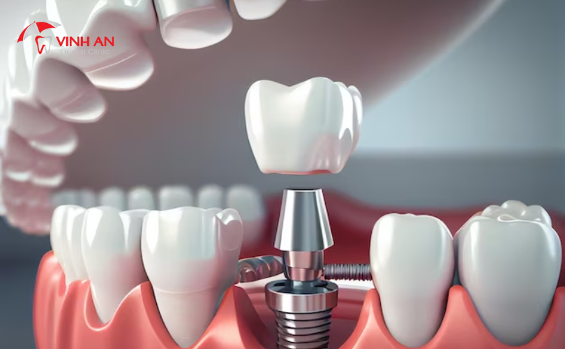 Trồng Răng Implant Là Gì 