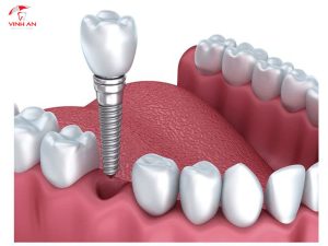 Trồng Răng Implant Là Gì? Quy Trình Và Bảng Giá Trồng Răng Implant