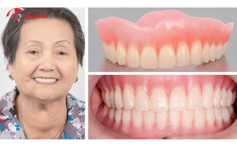 Review Trồng Răng Implant8