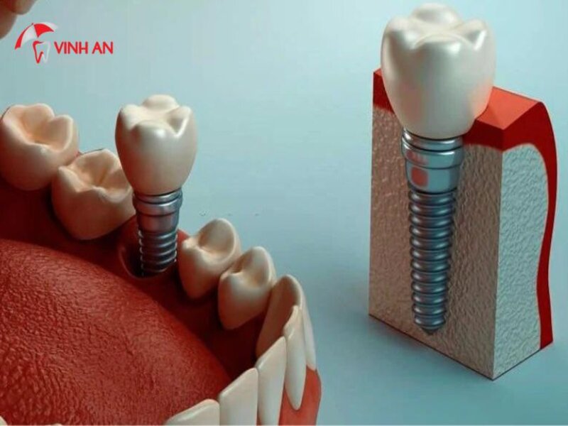 Trồng Răng Implant Có đau Không