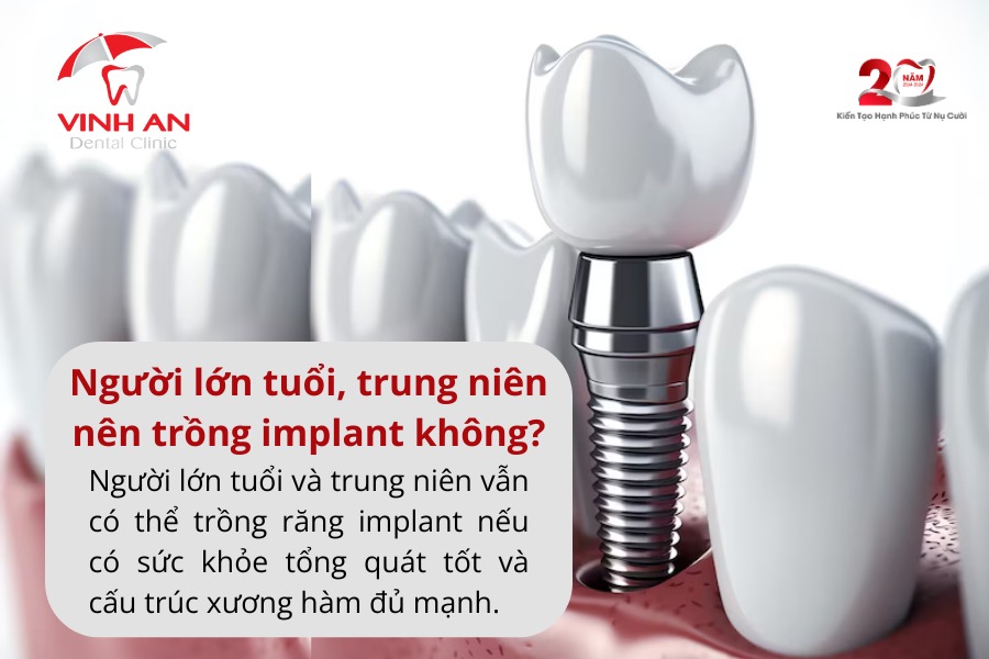 Nên Trồng Răng Implant Không 3