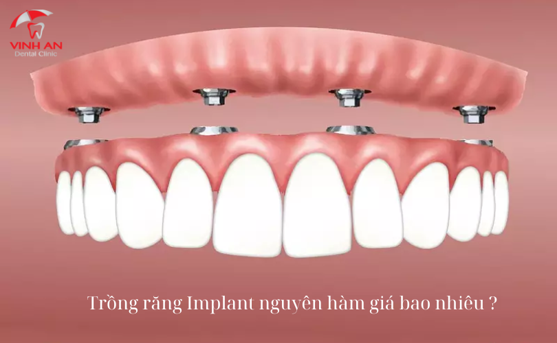 Trồng Răng Implant Nguyên Hàm