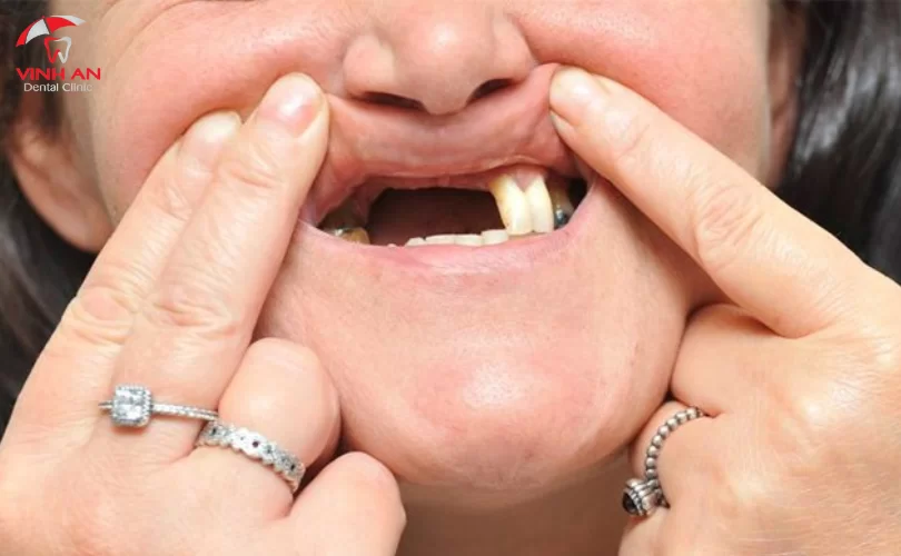 Trồng răng Implant nguyên hàm