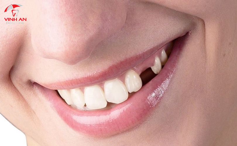 Trồng Răng Implant Nguyên Hàm