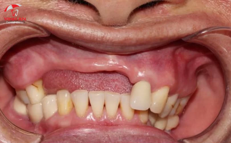 Trồng Răng Implant Nguyên Hàm