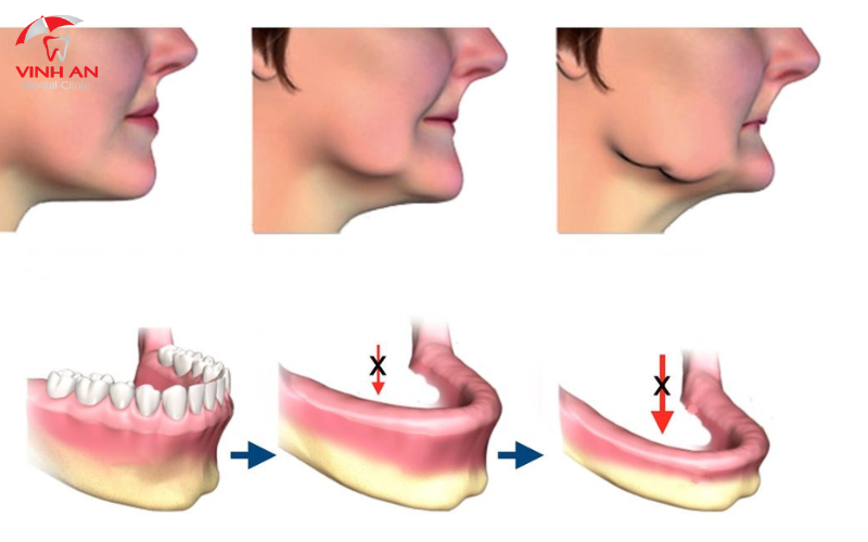 Trồng Răng Implant Nguyên Hàm.png 3