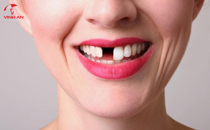 Trồng Răng Implant Nguyên Hàm.png 4