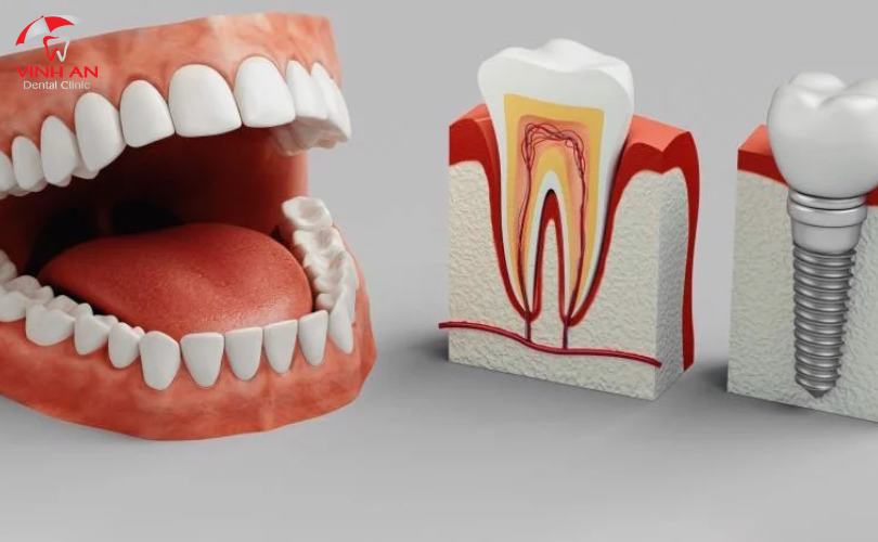 Trồng Răng Implant Nguyên Hàm.png 6