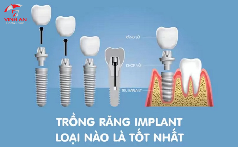 Trồng Răng Implant Nguyên Hàm.png 7