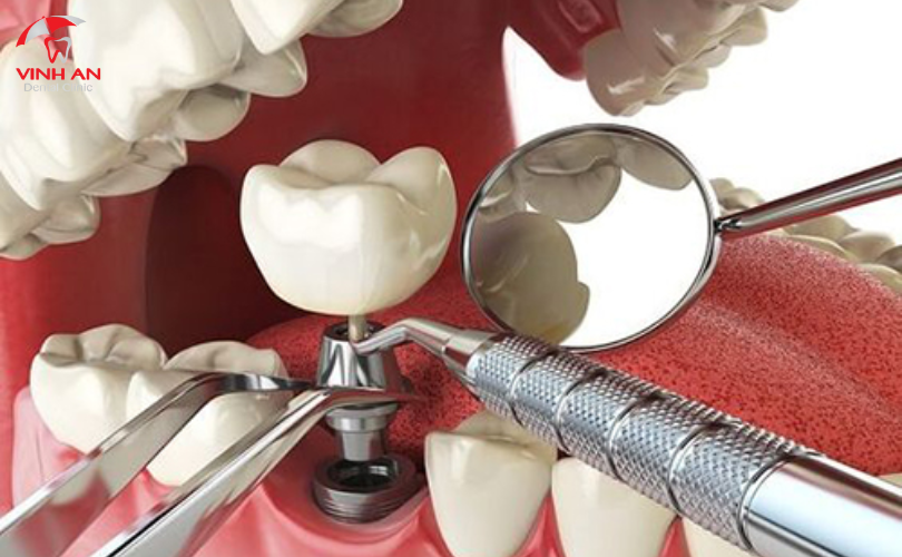 Trồng Răng Implant Nguyên Hàm.png 9