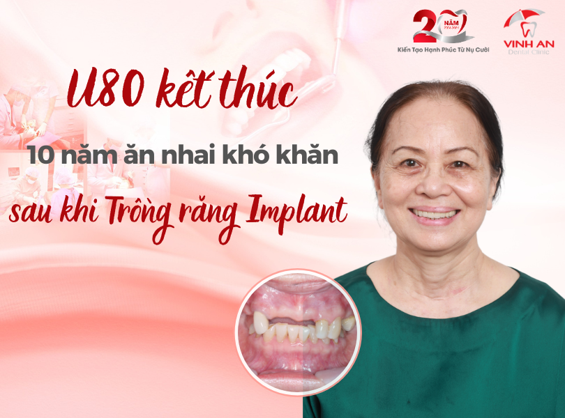 Ca Trồng Răng Implant Thành Công
