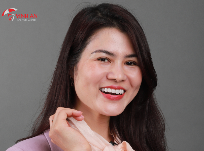 dán sứ Veneer