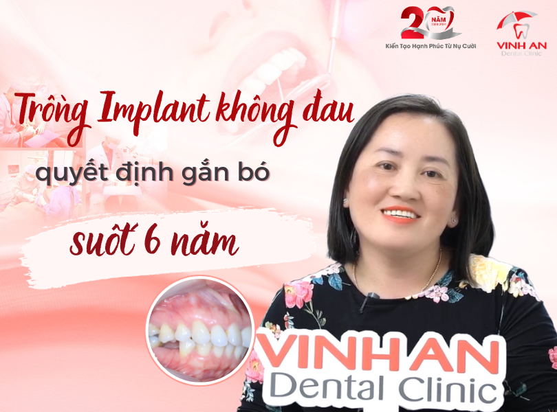 Việt kiều trồng răng Implant