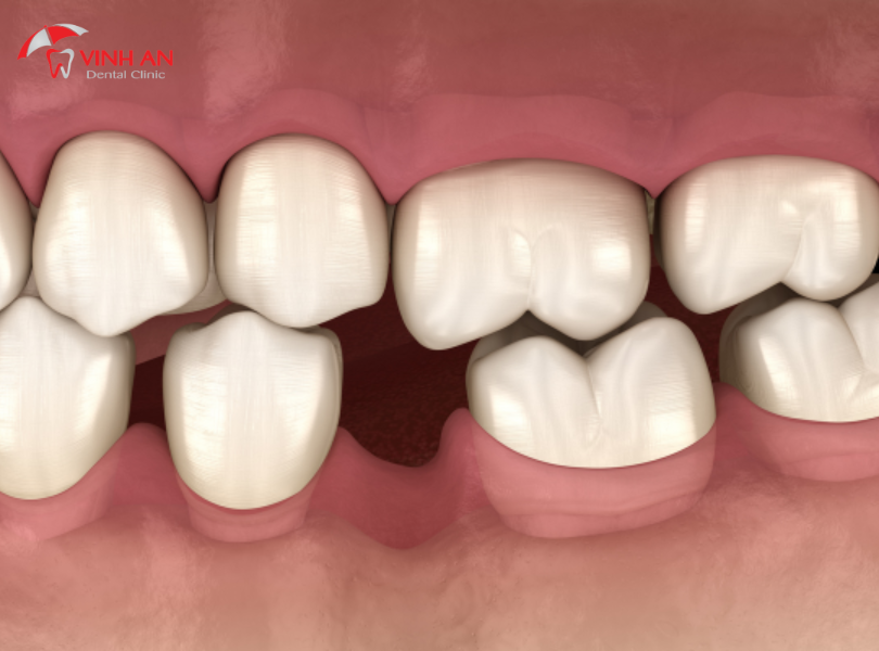 Trồng Răng Implant phương pháp phục hình răng hiệu quả