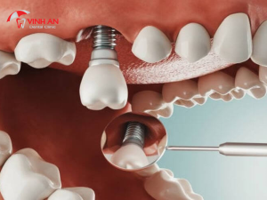 Trồng Răng Bằng Cấy Ghép Implant Có Thật Sự Tốt