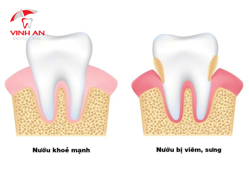 Viêm Nướu Quanh Răng Khôn