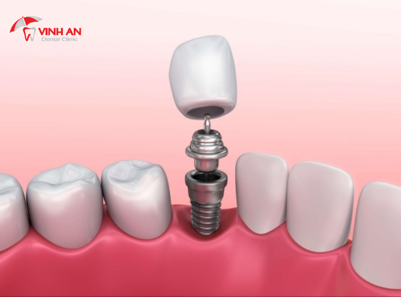 Phục Hình Răng Sứ Trên Implant 