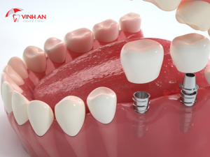 Phục Hình Răng Sứ Trên Implant