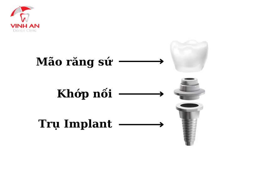trụ Implant làm bằng gì