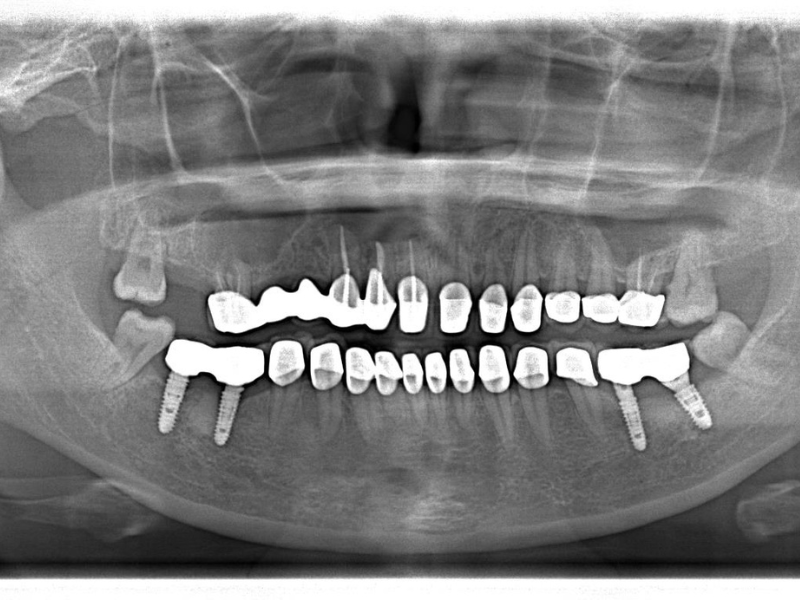 Trồng răng Implant số 7