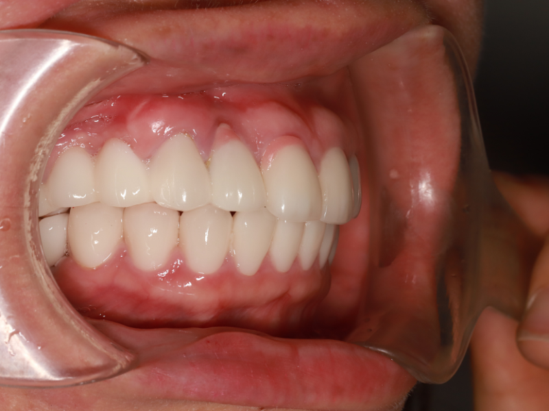 Răng Implant hoàn thiện sau khi phục hình
