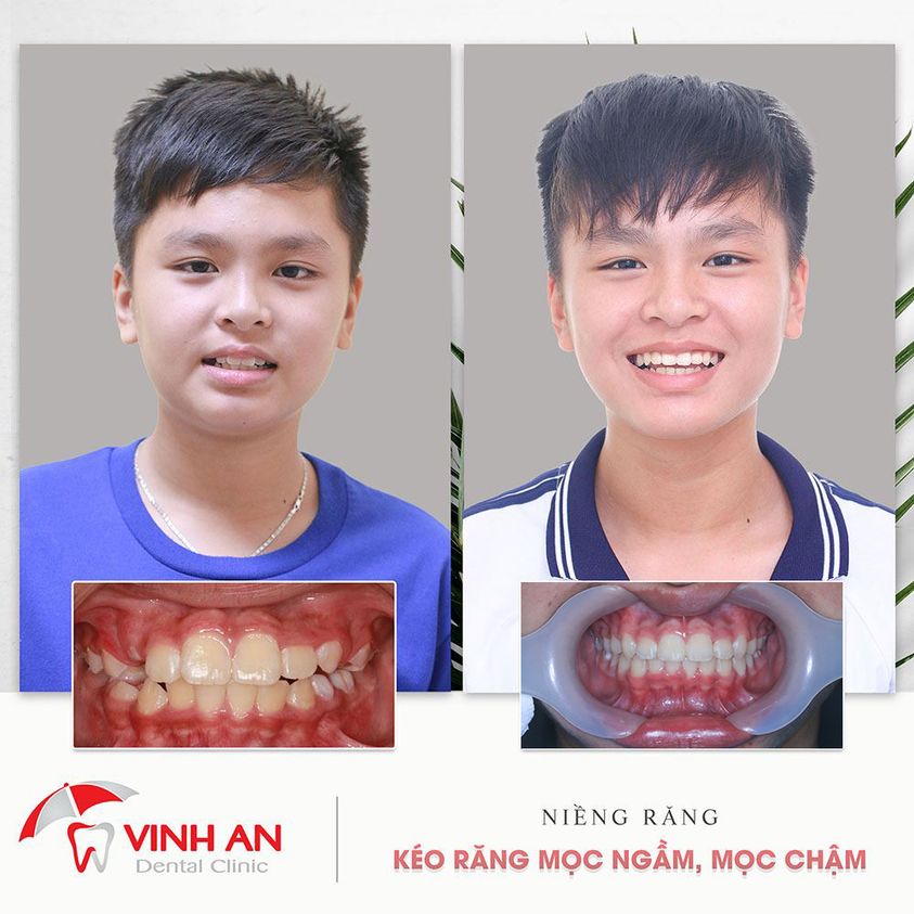 16 Tuổi Niềng Răng Bao Nhiêu Tiền 2