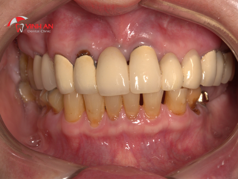 Tình trạng răng sứ cũ hư hỏng của chị Phượng
