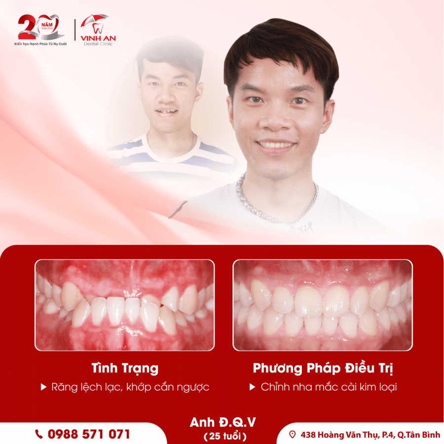 Tạm biệt khớp cắn ngược, hành trình đưa răng về đúng chỗ