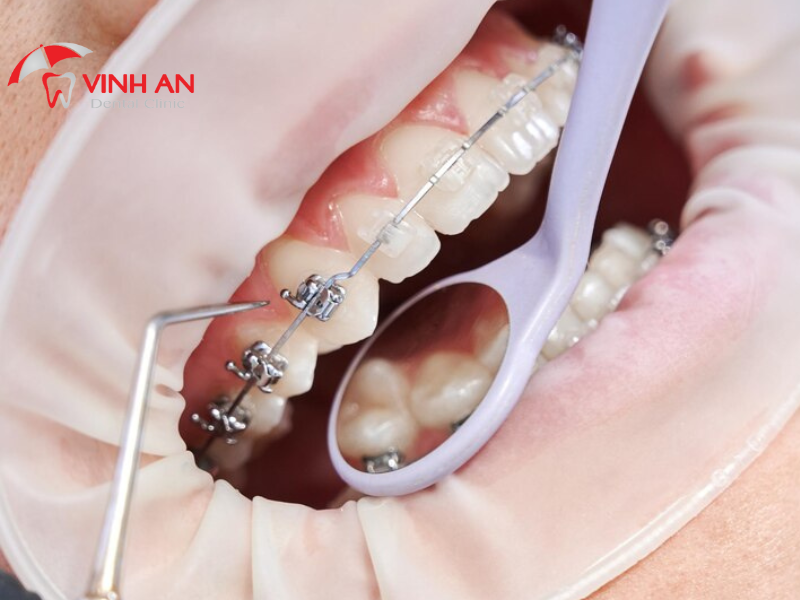 20 Tuổi Niềng Răng Bao Nhiêu Tiền? Niềng Răng Mắc Cài Kim Loại