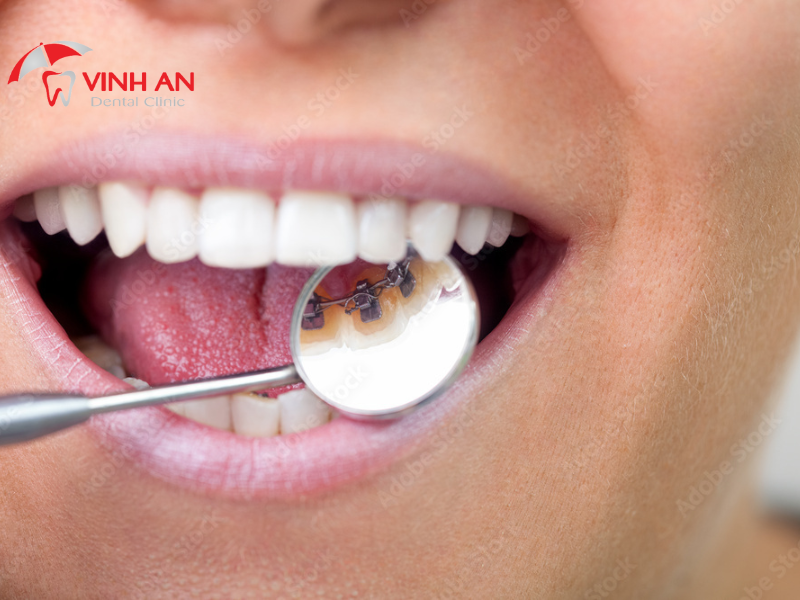 Niềng Răng Mắc Cài Lưỡi