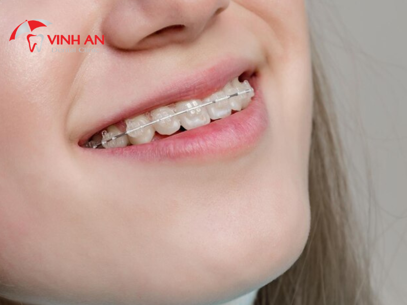 20 Tuổi Niềng Răng Bao Nhiêu Tiền? Niềng Răng Mắc Cài Sứ