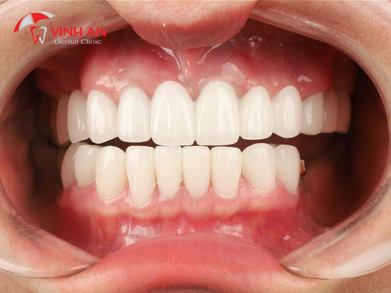 Giải pháp răng sứ cho nụ cười mới
