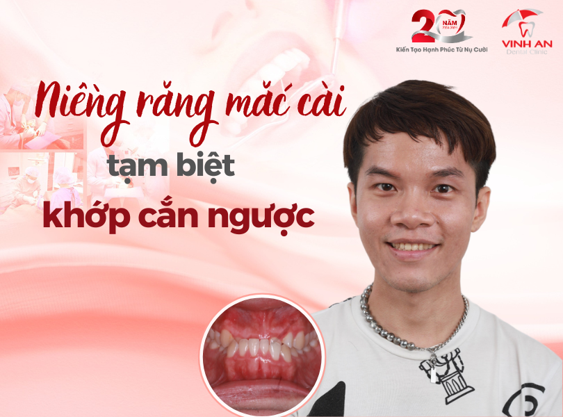 Tạm Biệt Khớp Cắn Ngược, Nâng Cấp Góc Nghiêng Thần Thánh