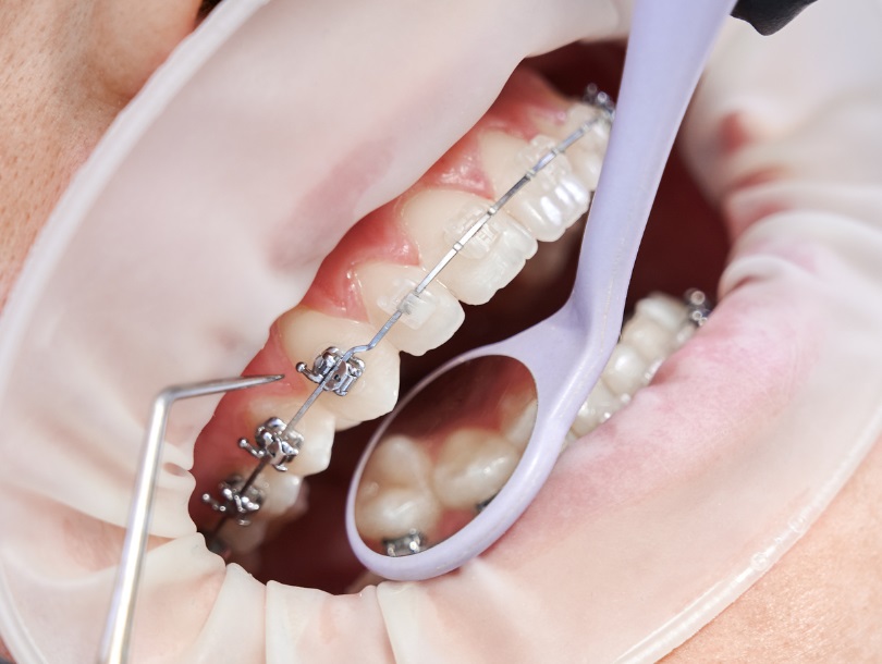 Niềng Răng Cho Trẻ 8 Tuổi