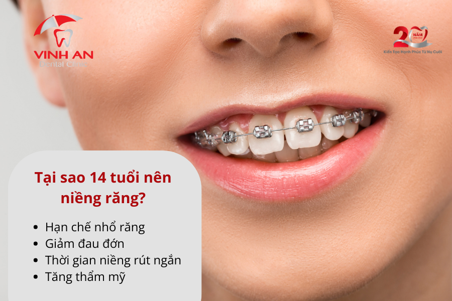 Niềng răng mắc cài kim loại