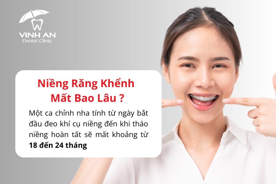 Niềng răng khểnh mất bao lâu?