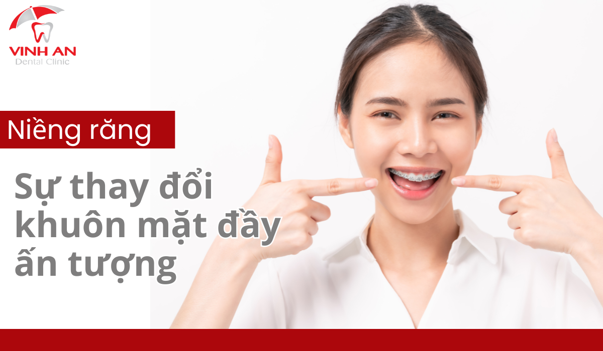 Kết quả niềng răng