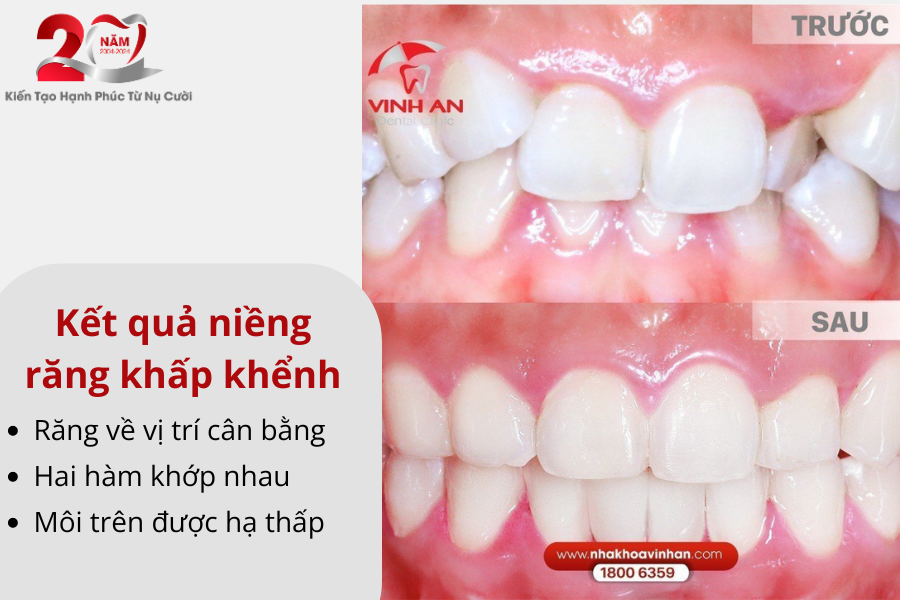 Kq Niềng Răng 5
