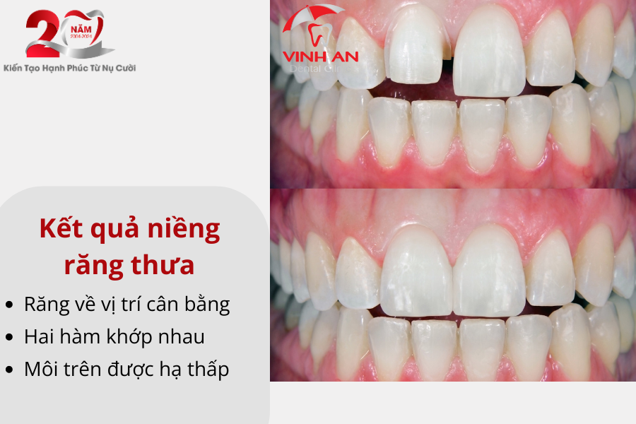Kq Niềng Răng 6
