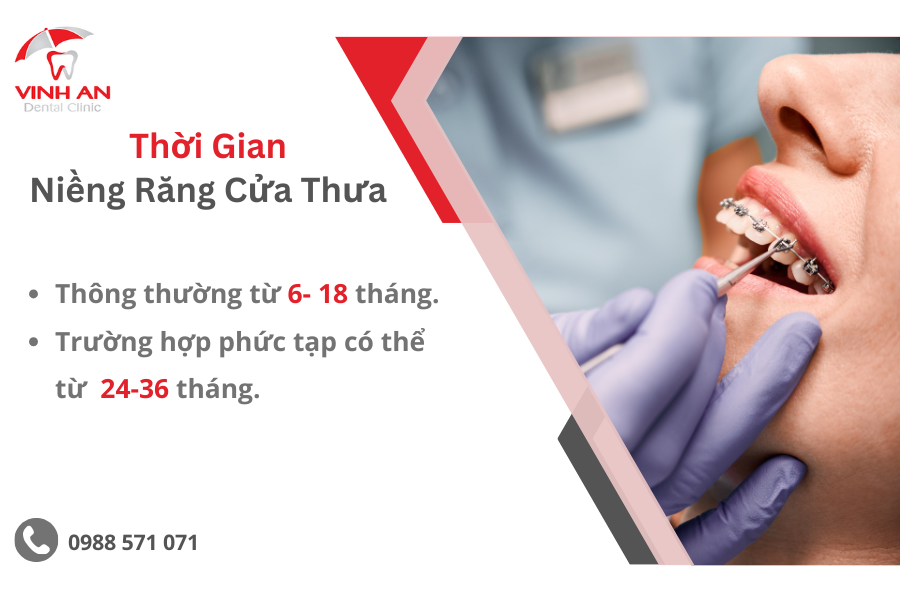 Niềng Răng Cửa Thưa Mất Bao Nhiêu Tiền 3