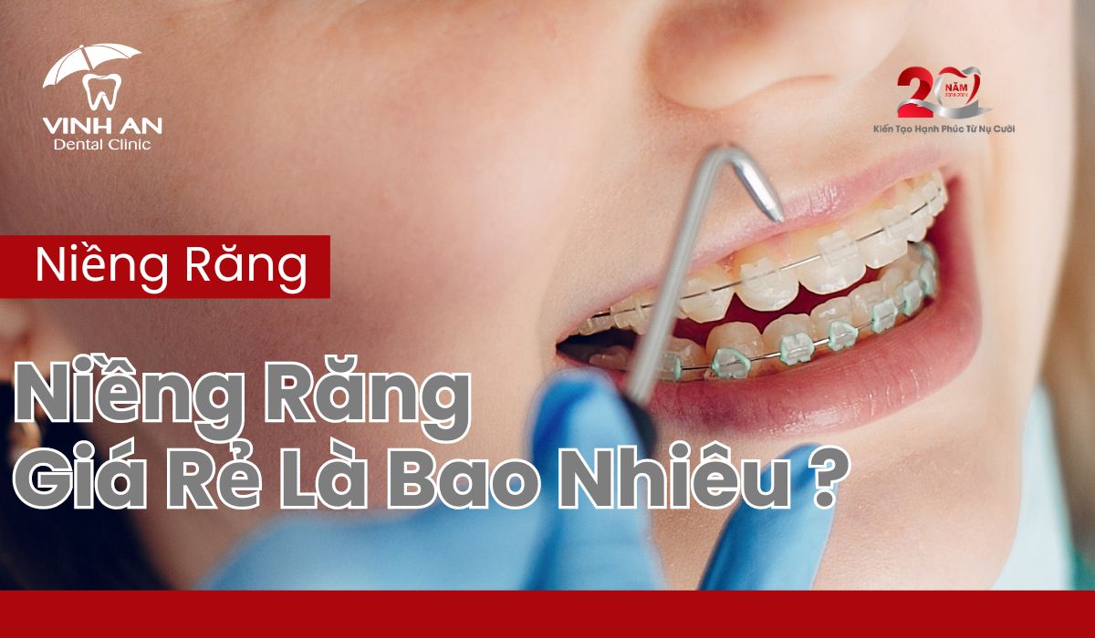 Niềng Răng Giá Rẻ Là Bao Nhiêu - Thumbnail