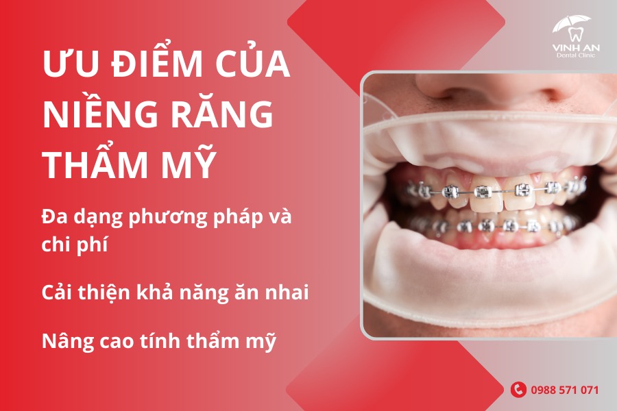 Niềng Răng Thẩm Mỹ